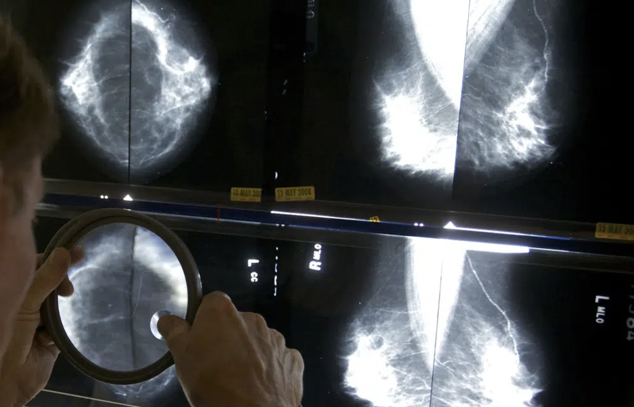 Us Requires New Info On Breast Density With All Mammograms Ndexnews